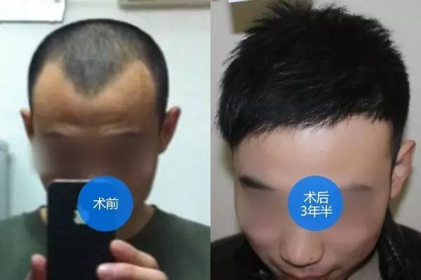 植发过程需要多长时间？植发注意事项有哪些