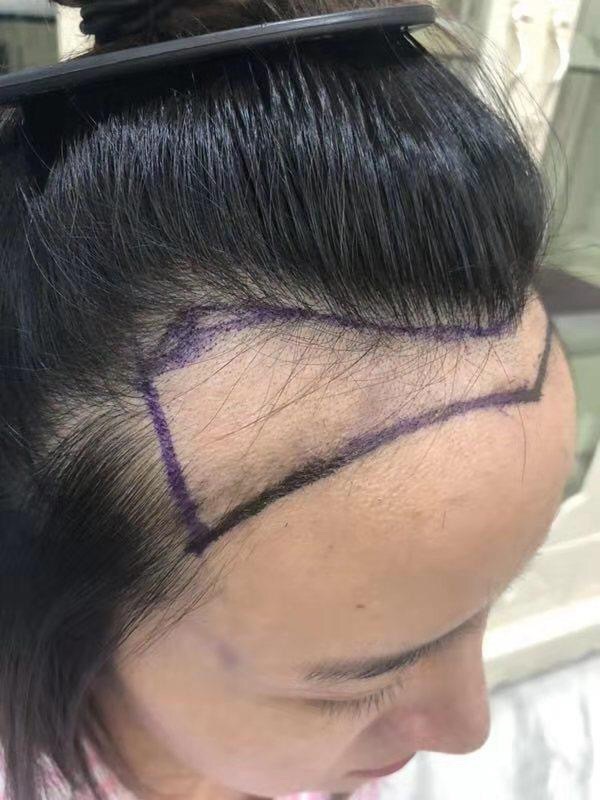 植发案例  你认识的明星也在做哦