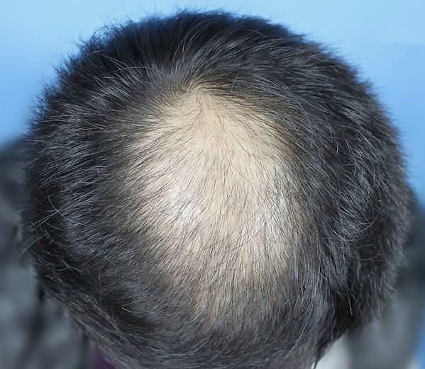 生发吃什么好呢？头发需要哪些元素才能生发呢？