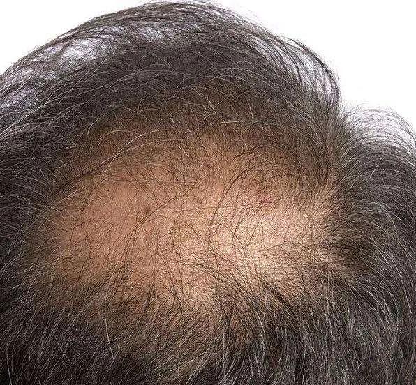 头顶脱发严重怎么办 头顶脱发怎么回事