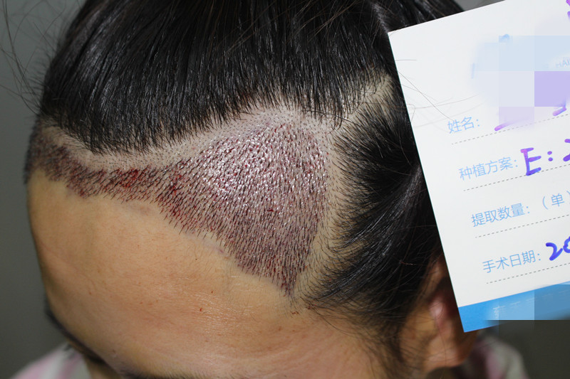 严重脱发是什么原因，怎么治疗严重脱发