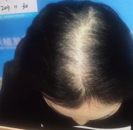 脱发严重怎么办脱发严重怎么办 如何治疗脱发