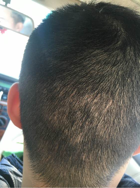 植发可以维持多久呢百度贴吧？如何预防植发的危害？