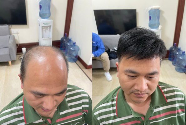 重庆男士假发定制哪家最好？（参考过来人评价）