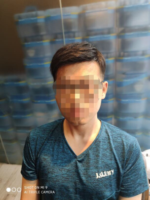 脂溢性脱发