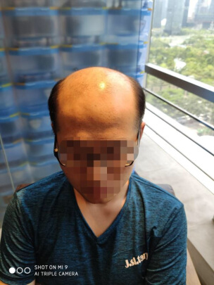 补发前效果
