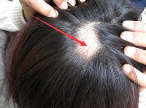 什么是脂溢性脱发？易患脂溢性脱发的人群！