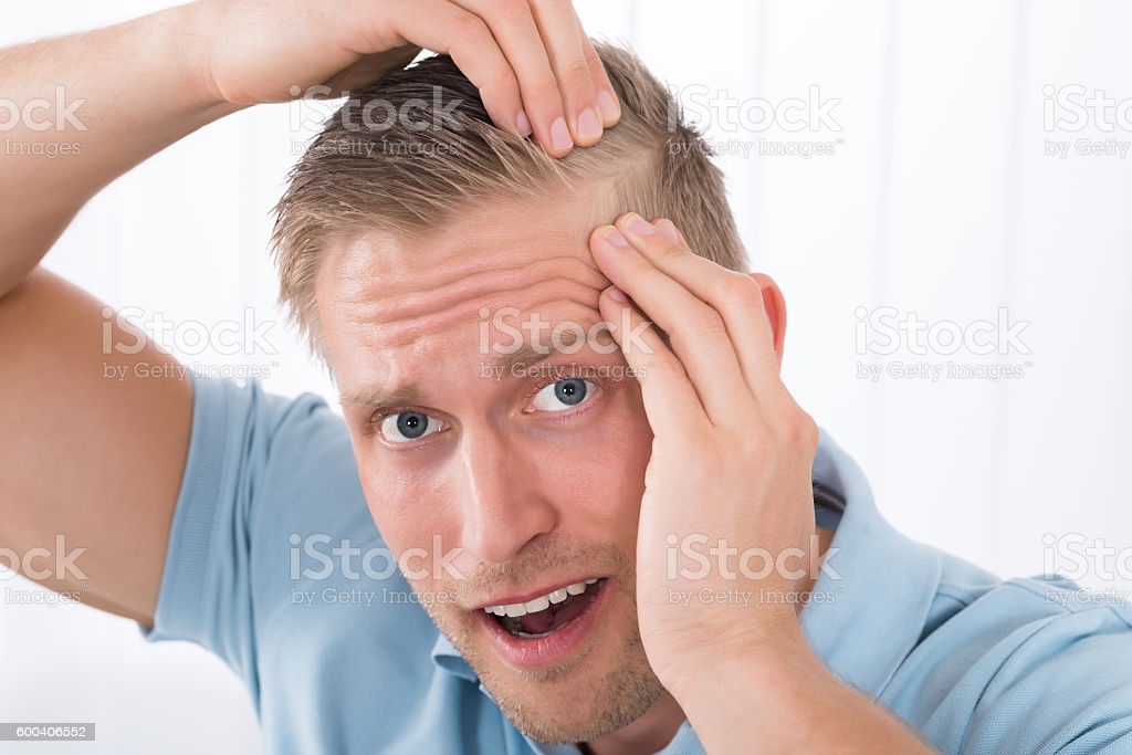 发际线后移怎么办？（发际线后移解答办法）