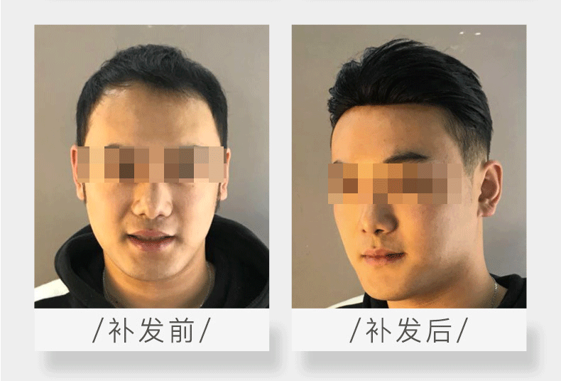 头发稀少增发有效吗？（权威解答）
