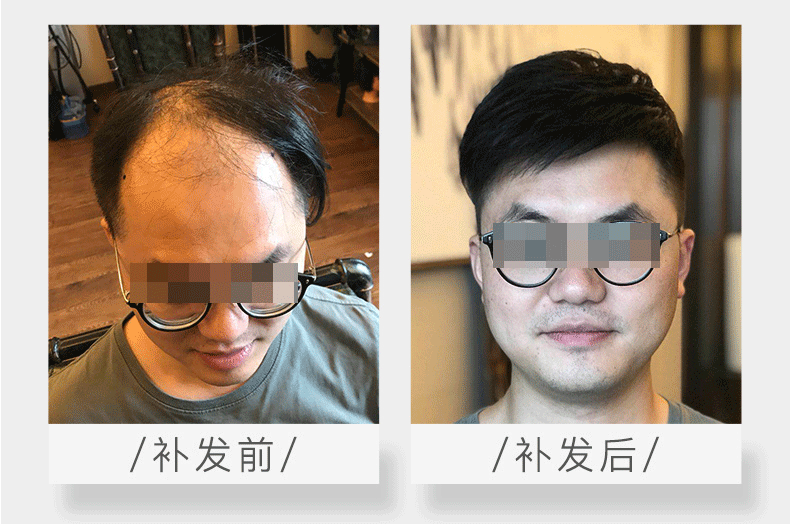 头发稀少增发有效吗