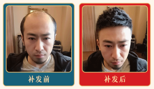 广州织发补发多少钱？（广州织发补发价格参考）