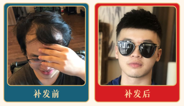 广州织发补发效果