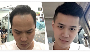织发补发半后对比效果