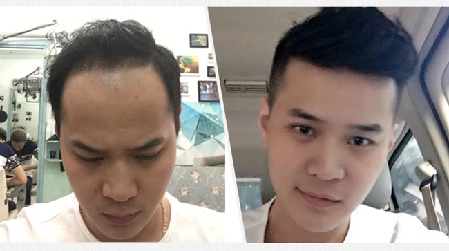 白头发如何变黑？（医生分享白头发变黑的建议）