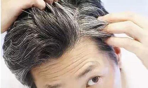 少年白怎么办？（少年白的解决办法）