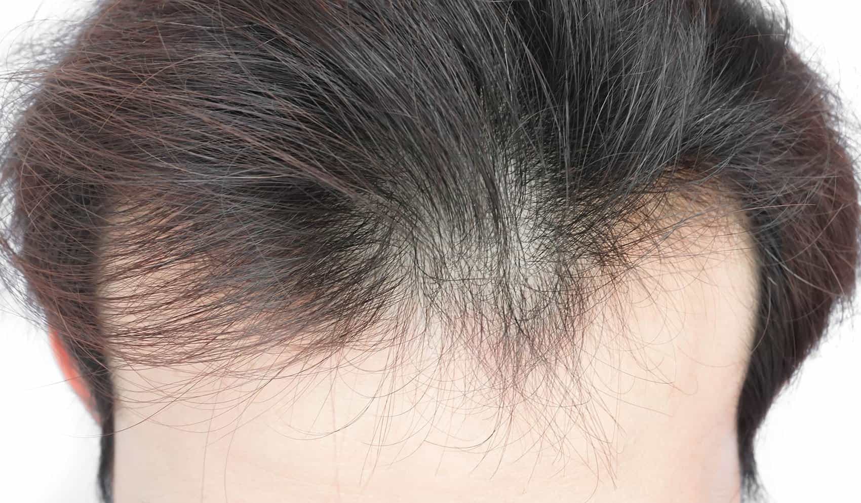 头发稀少哪家好？（过来人推荐头发稀少问题解决商家）