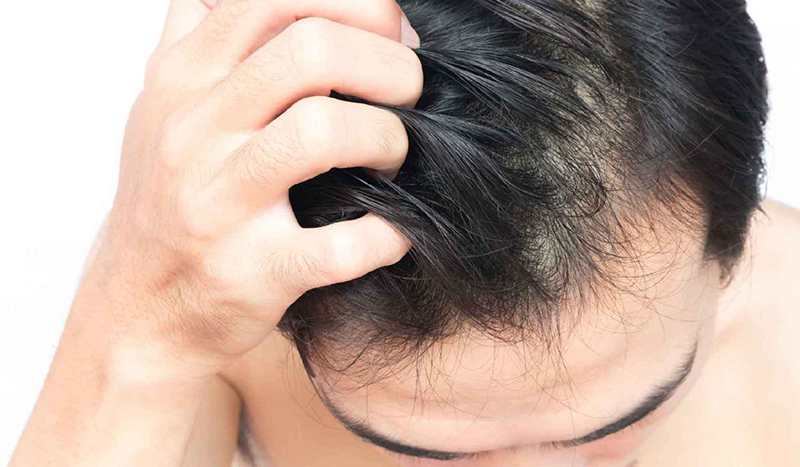男性脱发的原因有几种？（医生分享）