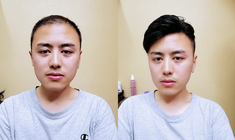 男生头发少可以烫发吗？权威医生分享（少发星人看过来）