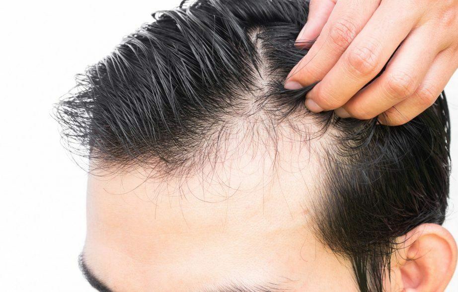 怎么控制脱发？（控制脱发的正确方法）