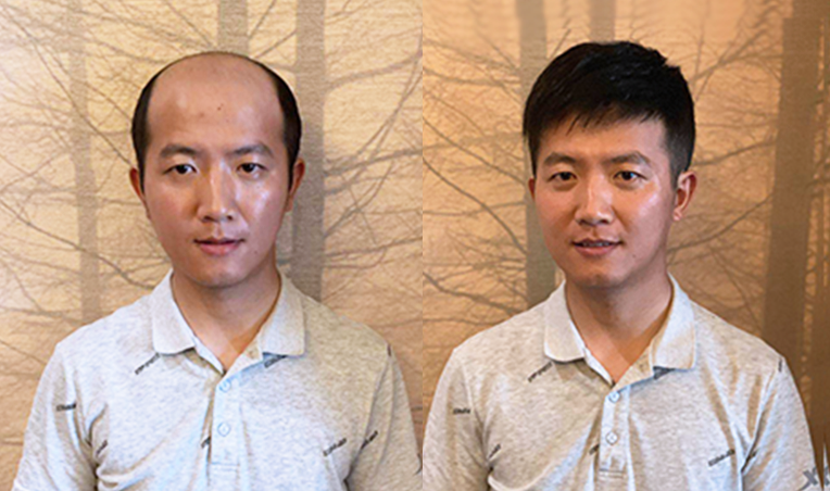 织发多少钱？哪家织发效果好？（织发问题解答）