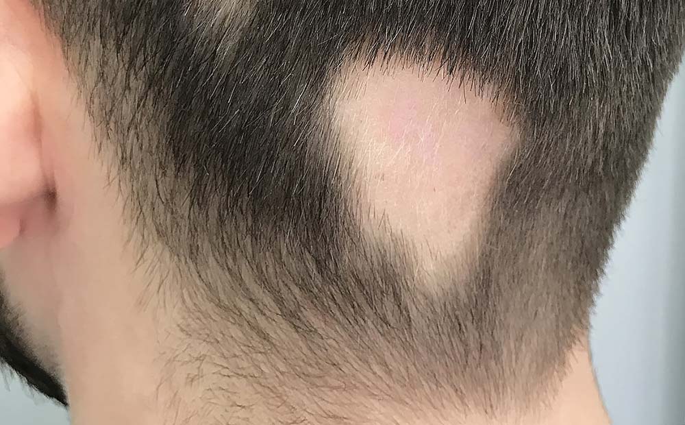 休止性脱发是什么原因？（休止性脱发的真正原因）