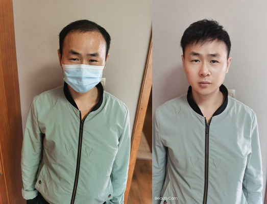 戴假发会不会使脱发更严重？（过来人分享）