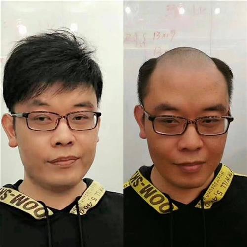 织发补发一般能连续使用多久? 织发补发后怎么清洗保养?