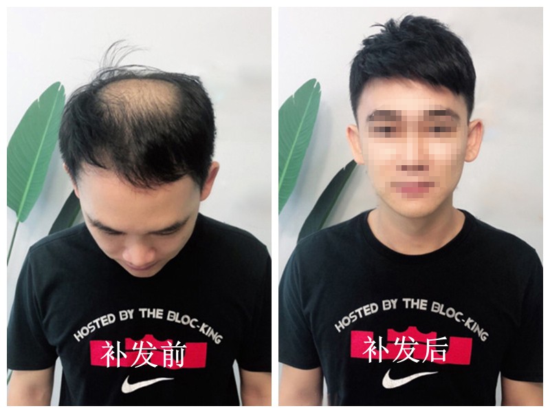 再出发脱发白发养发 怎么去拯救你的头发