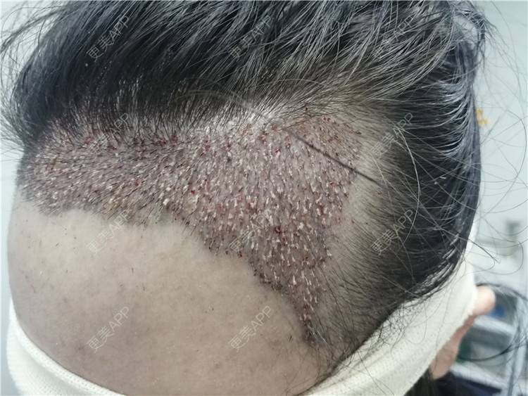 植发后你需要在生活中注意什么