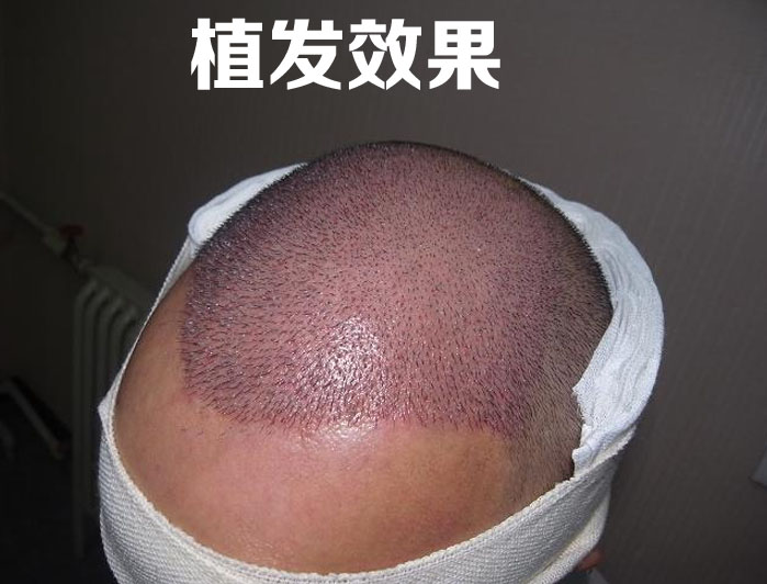 植发后你需要在生活中注意什么