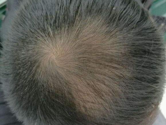 吃什么生发效果最好？如何自查自己是否脱发？