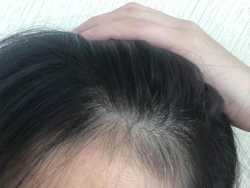 吃什么生发效果最好