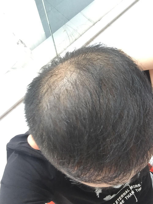 植发一年后又脱发