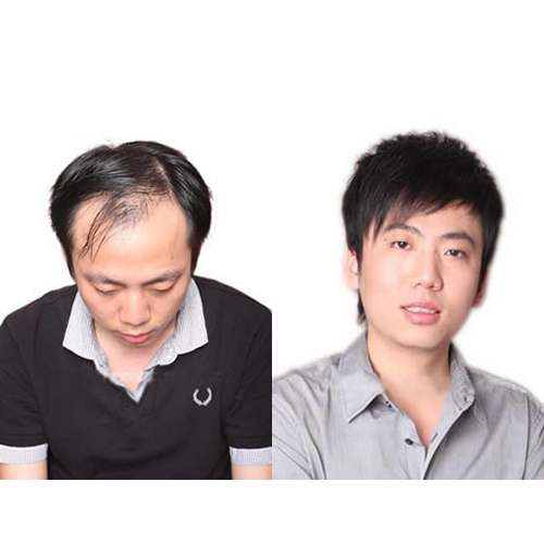 补发什么意思,补发后应该怎样护理？