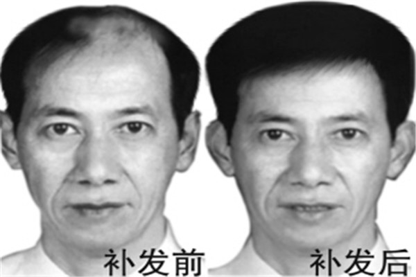 补发织发多少钱便宜?补发织发多久换一次