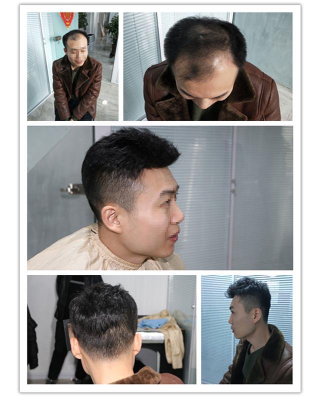 织发补发价格一般是多少?