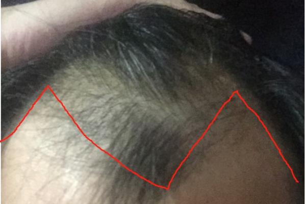 植发注意事项须知，植发的原理是什么呢？