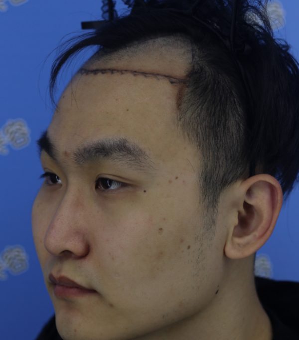 植发注意事项须知,植发的原理是什么呢?