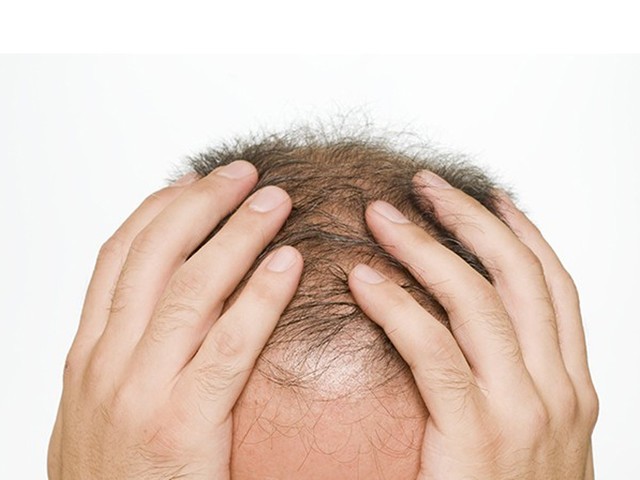 男人植发要多少钱一般？效果如何？