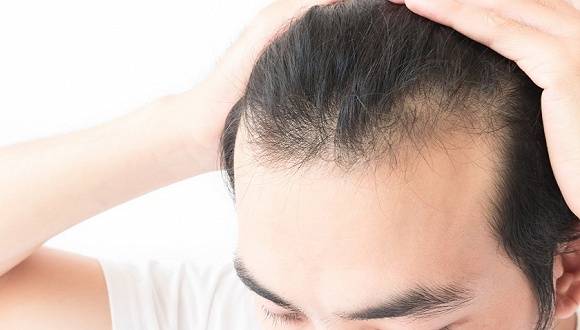 男人植发要多少钱一般