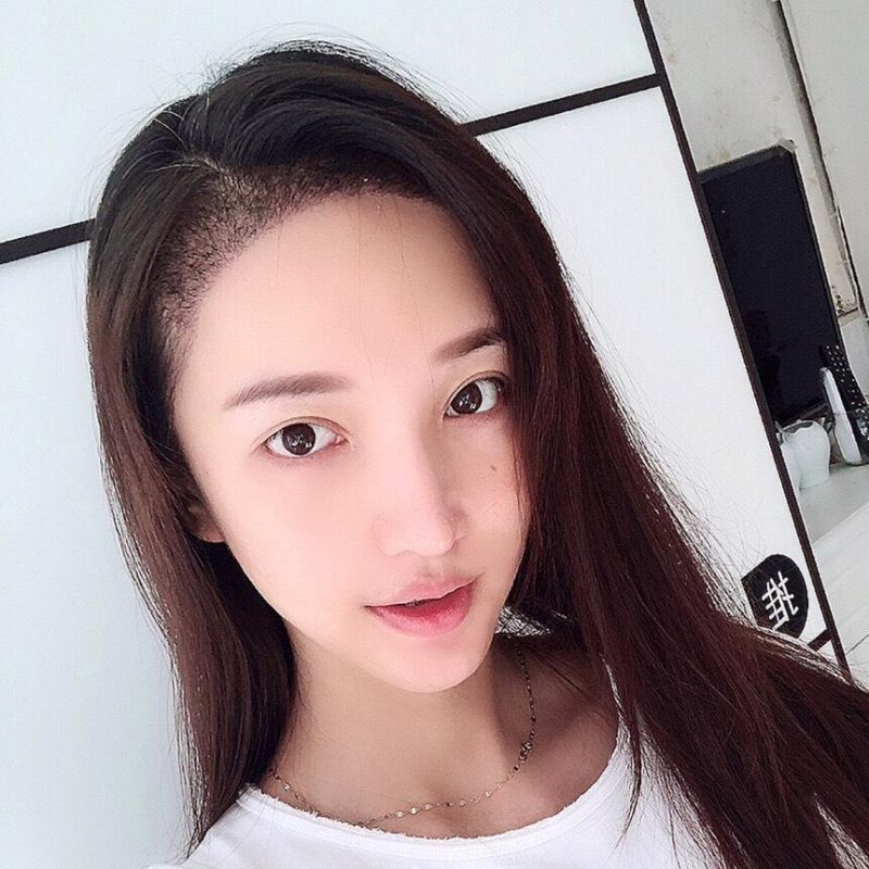 植发是什么技术？发际线植发要多少钱一般？