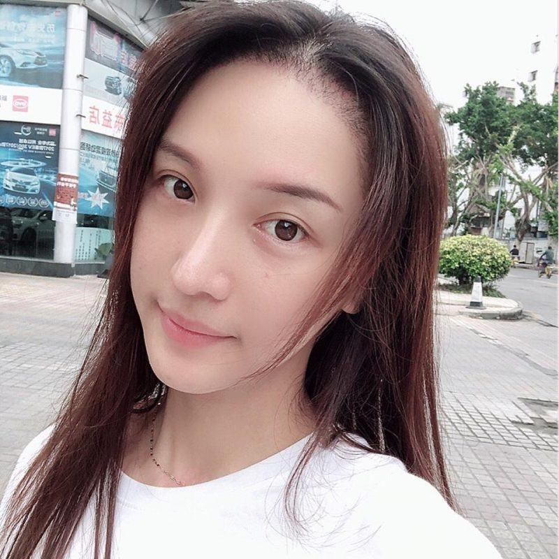 植发是什么技术?发际线植发要多少钱一般?