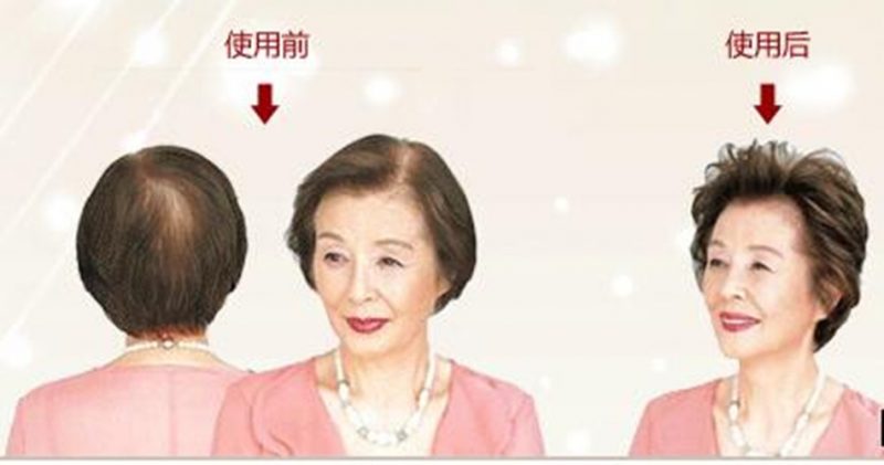 上海织发补发价格多少钱?织发补发有什么优势?