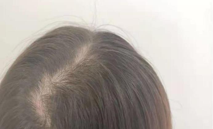 脱发严重怎么办?脱发严重有什么方法？