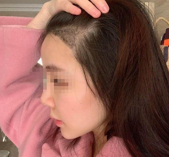 植发靠谱吗,会有什么危害吗?