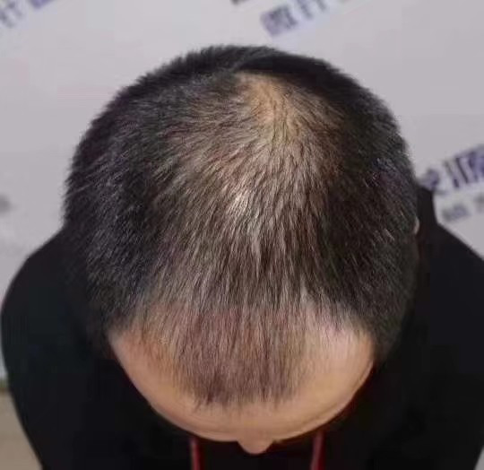 植发可以维持多久