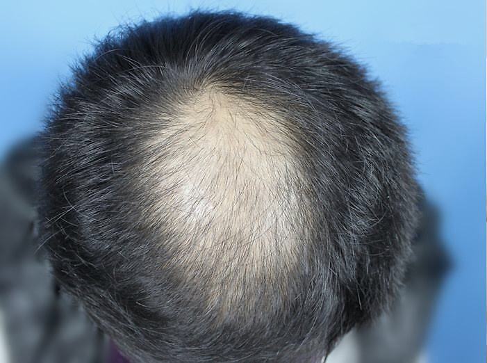 男人生发吃什么最好？男人掉头发吃什么好？