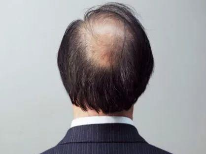 男生生发吃什么最好？生发的误区有哪些？