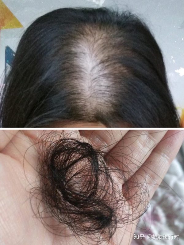 脱发严重怎么办？是什么原因引起的脱发严重？