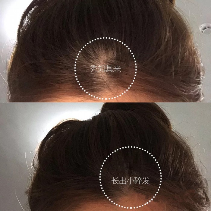 脱发严重怎么办